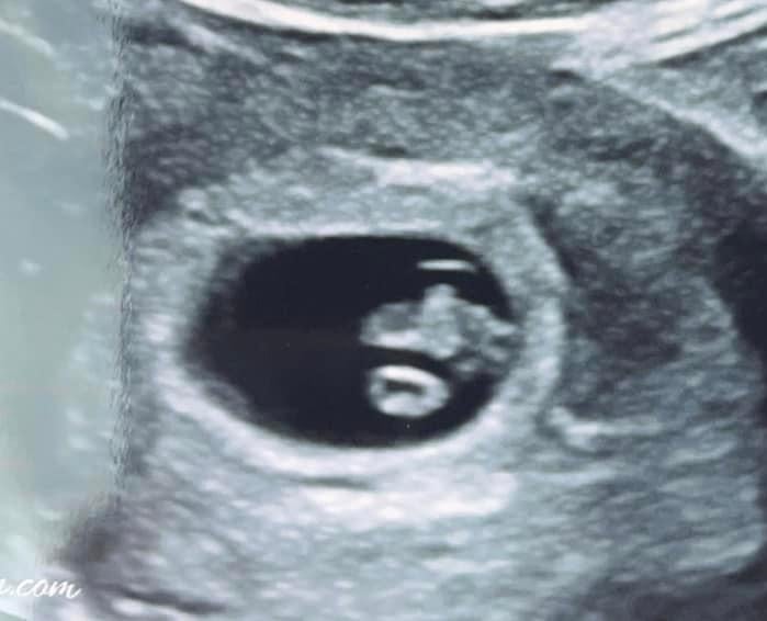 7 weeks pregnant and both the yolk sac and fetus are visible