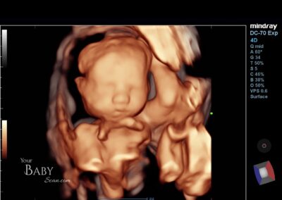 4D ultrasound image of a 26-week fetus with arms positioned in front of the face, showcasing realistic imaging challenges such as cord and fluid positioning, from Your Baby Scan.